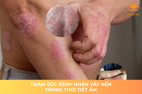 Chăm Sóc Bệnh Nhân Vẩy Nến Trong Thời Tiết Ấm 